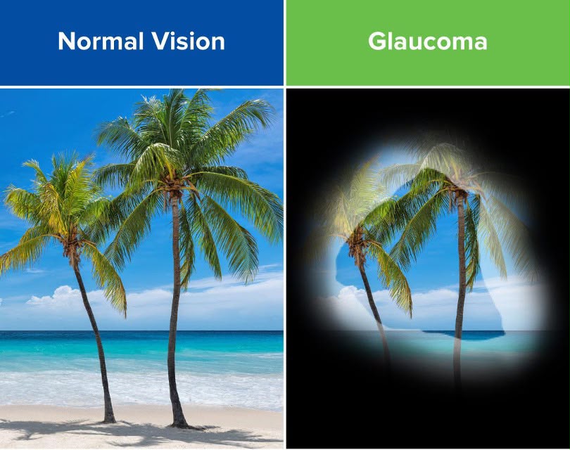 Pterygium on eye