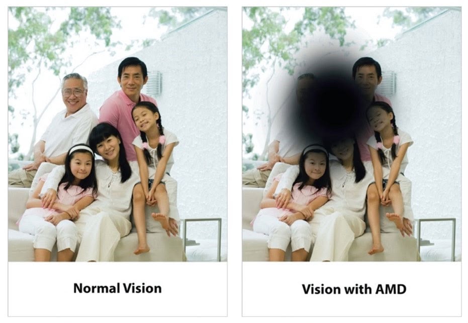 Pterygium on eye