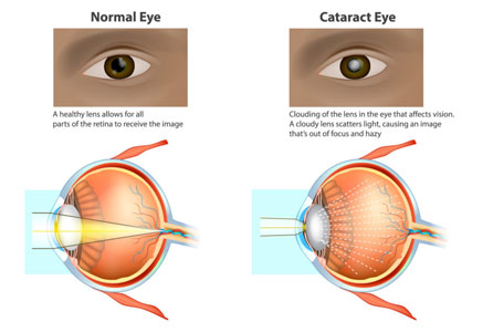 Pterygium on eye
