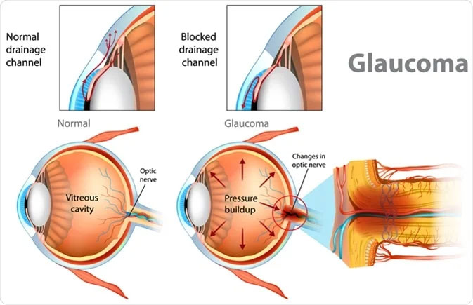 Pterygium on eye
