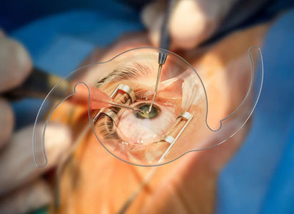 Cataract Surgery Borivali