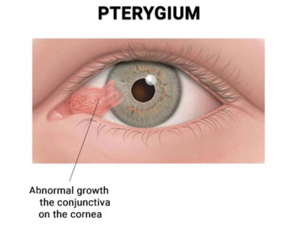 Pterygium on eye