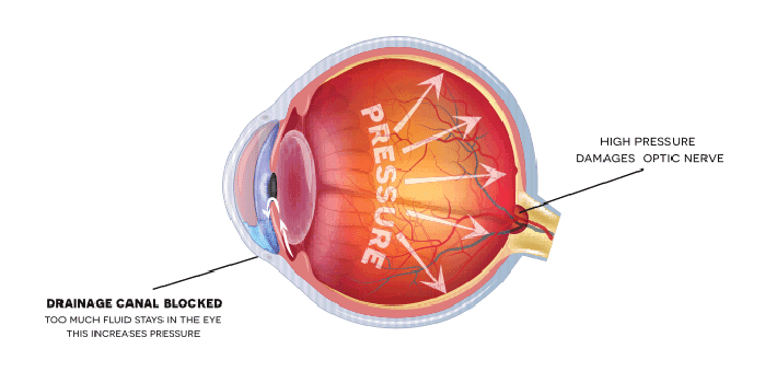Glaucoma Treatment at Amavi Eye Clinic