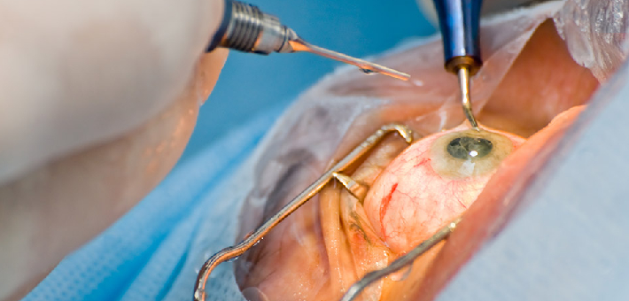 Cataract Surgery at Amavi Eye Clinic