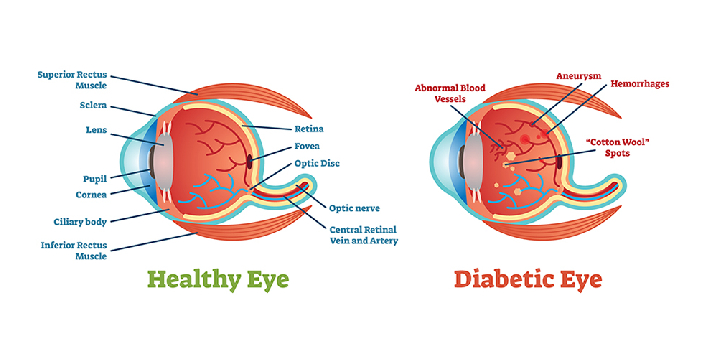 Diabetic Retinopathy Treatment at Amavi Eye Clinic