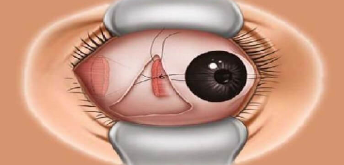 Squint Surgery at Amavi Eye Clinic